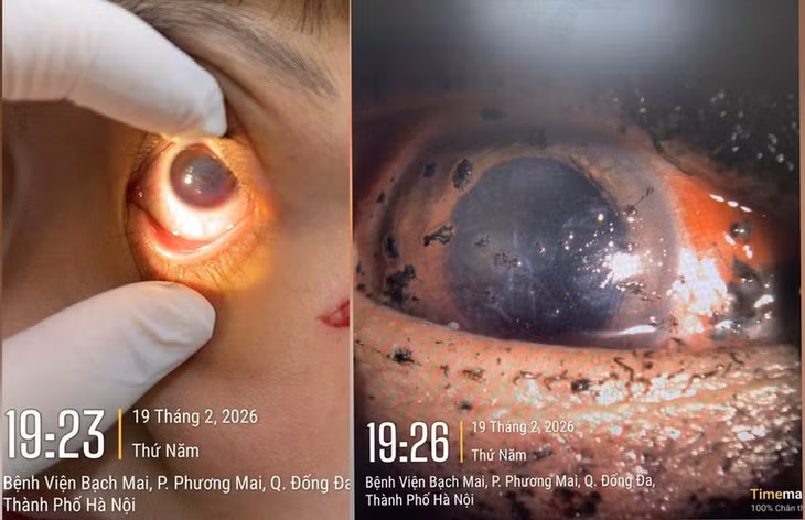 Mắt bị tổn thương do pháo nổ.