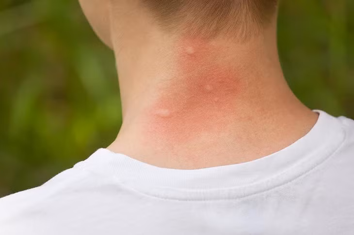Côn trùng đốt là tình huống phổ biến trong các chuyến du xuân.