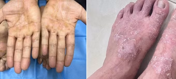 Mùa đông có thể làm tình trạng viêm da cơ địa nặng hơn - Ảnh: BSCC