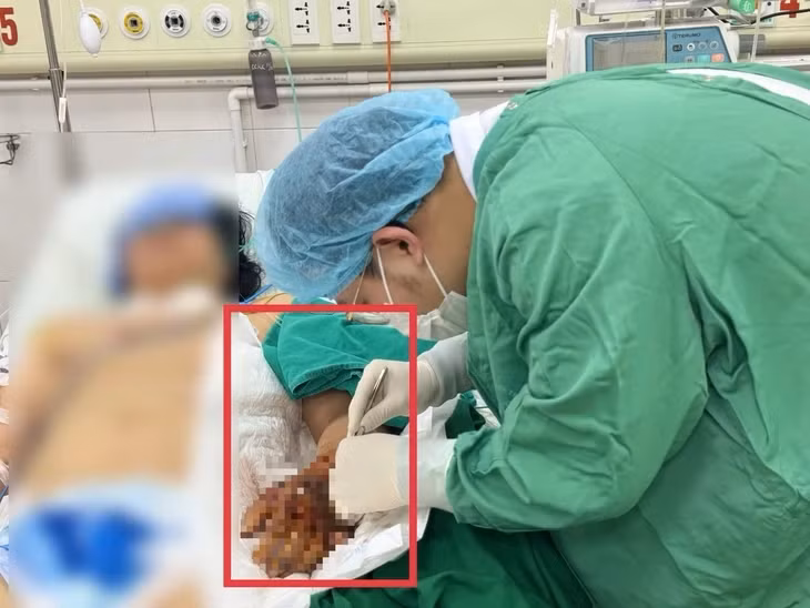 Bác sĩ Bệnh viện Bệnh nhiệt đới Trung ương xử lý vết thương cho bệnh nhân - Ảnh: BVCC