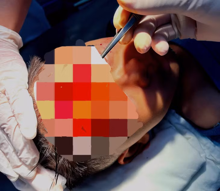 Các bác sĩ tiến hành điều trị cho bé trai 7 tuổi bị chó cắn vào vùng mặt - Ảnh: Bệnh viện cung cấp