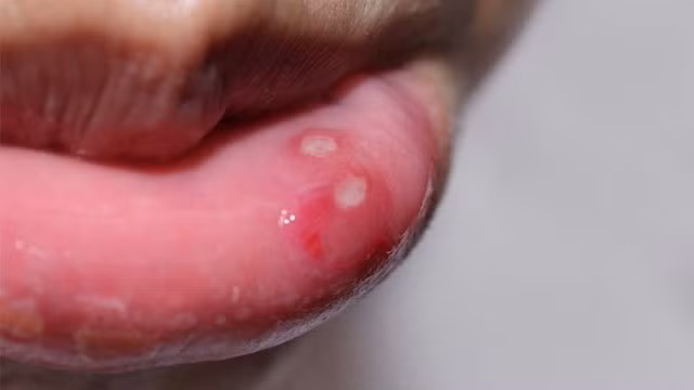 Hầu hết mọi người bị nhiệt miệng với những vết loét nông, kích thước từ 1 - 2 mm thường tập trung ở vùng lợi, má trong hoặc lưỡi.