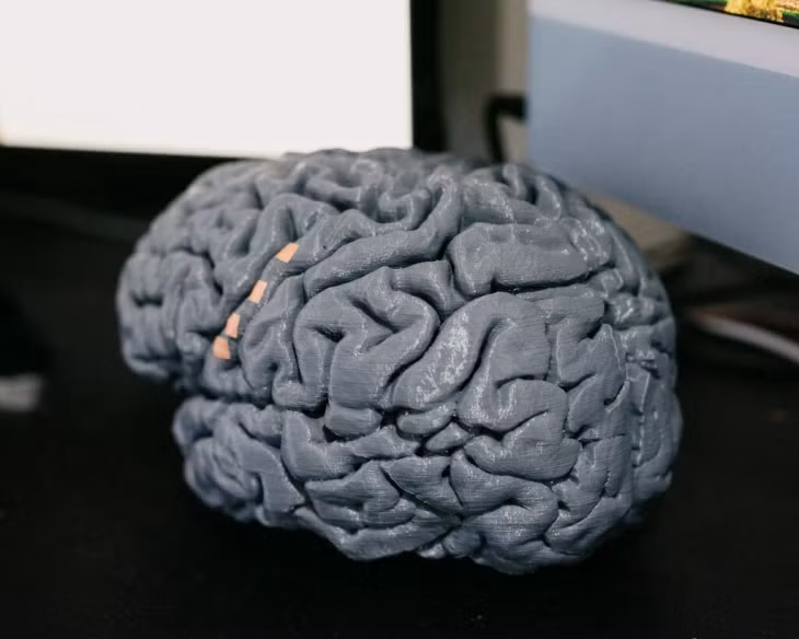 Bản in 3D não của Harrell, giúp các nhà khoa học tinh chỉnh thiết bị cấy ghép. Ảnh: New York Times.