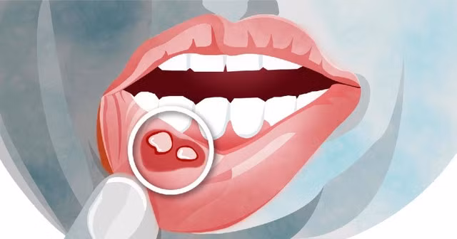 Nhiệt miệng (viêm loét miệng) là những ổ loét nông, nhỏ trên bề mặt niêm mạc khoang miệng, lưỡi, nướu...