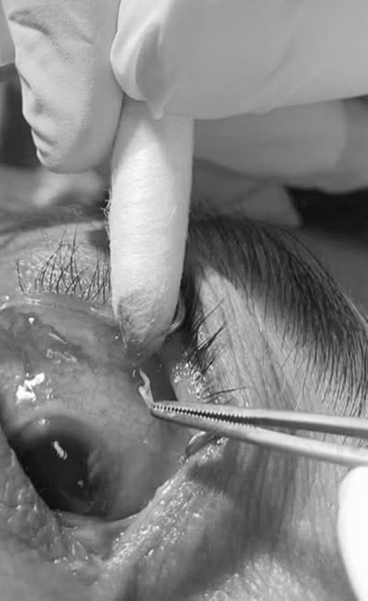 Trường hợp người bệnh viêm thượng củng mạc mắt do ký sinh trùng (giun đũa chó, mèo) xâm nhập vào tổ chức dưới kết mạc được điều trị tại Bệnh viện Việt Nam - Thụy Điển Uông Bí. Ảnh do bệnh viện cung cấp