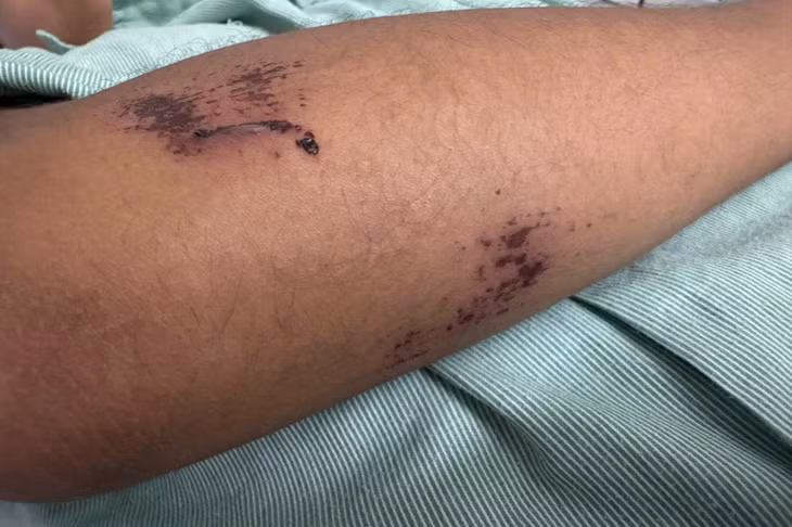 Nhóm thiếu niên truy đuổi khiến nam sinh ngã ra đường với nhiều vết thương. Ảnh: Đinh Đại