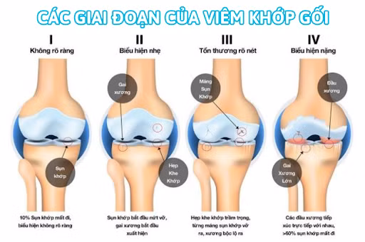 Các giai đoạn của bệnh viêm khớp gối