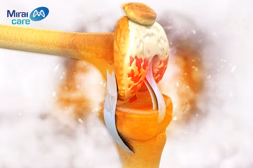 Viêm khớp gối là gì? Cách điều trị bệnh viêm khớp gối