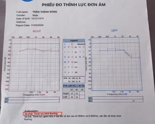 Sau 2 tháng dùng Kim Thính thính lực tai phải của anh Song đã trở lại bình thường