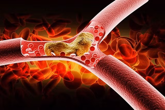 Mỡ máu cao (cholesterol máu cao) gây ra rất nhiều tác động xấu đến sức khỏe.