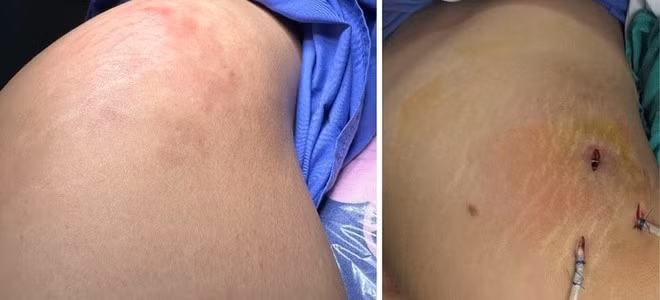 Vùng tổn thương của chị N. trước và sau khi được xử lý. Ảnh: BVCC.
