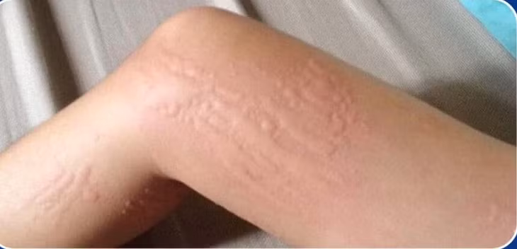 Biểu hiện nổi mề đay do lạnh.