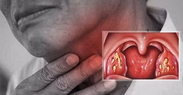 Viêm họng do vi khuẩn không được điều trị kịp thời dễ dẫn đến biến chứng viêm amidan, nhiễm trùng tai,...