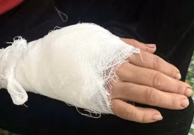 Cánh tay của bà Chiến bị khỉ đuôi lợn tấn công dẫn tới bị thương.