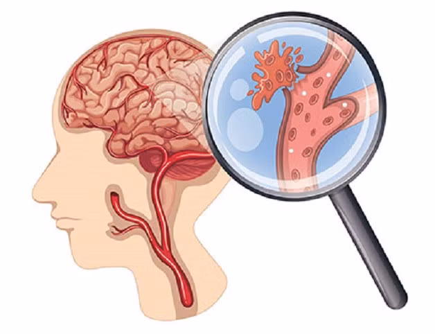Trong những năm gần đây, tình trạng đột quỵ đang có xu hướng gia tăng ở người trẻ tuổi.
