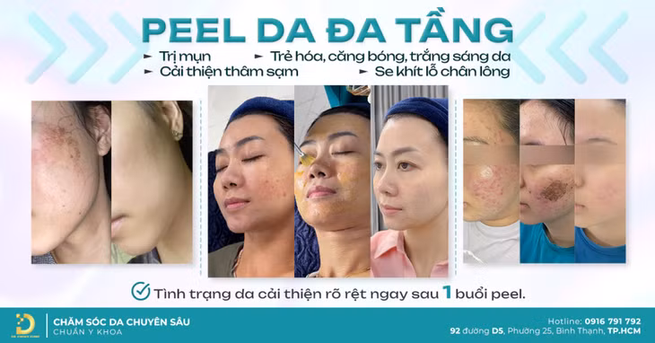 Top 4 địa chỉ peel da, thay da sinh học uy tín ở TPHCM ảnh 2
