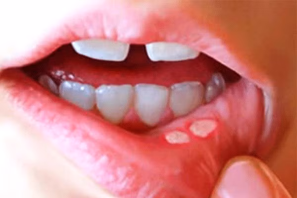 Đối với trẻ nhỏ, nhiệt miệng là một trong những căn bệnh phổ biến và gây khó chịu nhất.