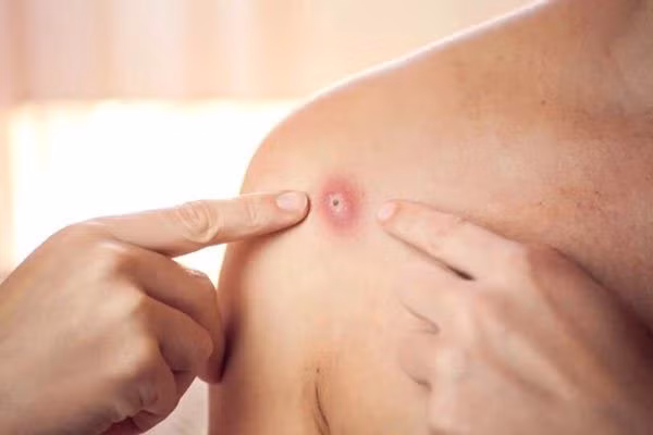 Nốt đậu mùa là biểu hiện rõ nhất của căn bệnh đậu mùa khỉ.