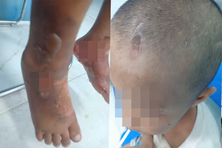 Cháu K. bị nhiều thương tích vào đầu và bỏng nặng ở 2 chân do nước sôi. Ảnh: Gia đình cung cấp