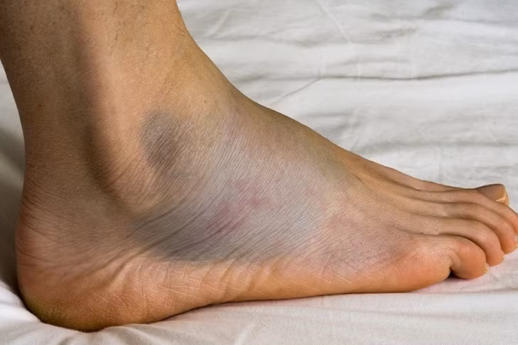 Sưng phù ở chân cũng có thể là dấu hiệu của suy tim. Ảnh: Healthline