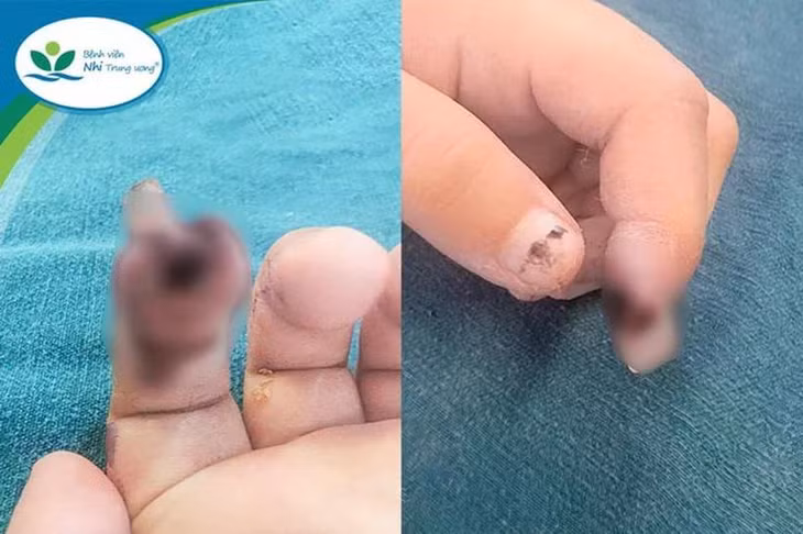 Tình trạng ngón tay trẻ bị đứt rời. (Nguồn: Bệnh viện Nhi Trung ương)