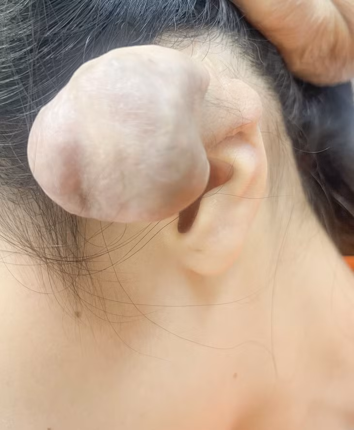 Sụn vành tai chị T. bị nhiễm trùng, biến dạng phình to. Dù đã cắt bỏ nhưng khối u vẫn bị mọc lại sau 2 năm cắt tai.Ảnh: BV