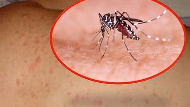 Bệnh sốt xuất huyết nếu không điều trị kịp thời, đúng cách có thể dẫn đến các biến chứng như sốc sốt xuất huyết, suy hô hấp...