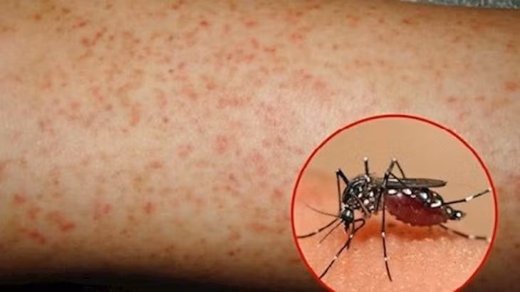 Sốt xuất huyết với phụ nữ mang thai nghiêm trọng hơn người bình thường.