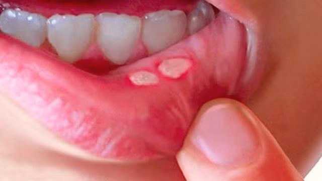 Nhiệt miệng được đặc trưng bởi các vết loét ở miệng, đau nhiều và dễ tái phát.