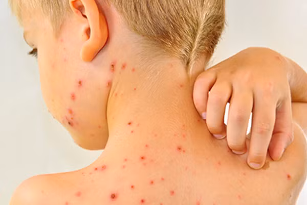 Nhiều người cho rằng, vừa mắc sốt xuất huyết xong sẽ không mắc lại bệnh.