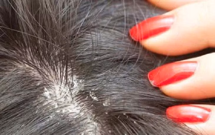 Nấm sinh trưởng và phát triển mạnh trong môi trường ấm áp, độ ẩm cao và da đầu là nơi lý tưởng.