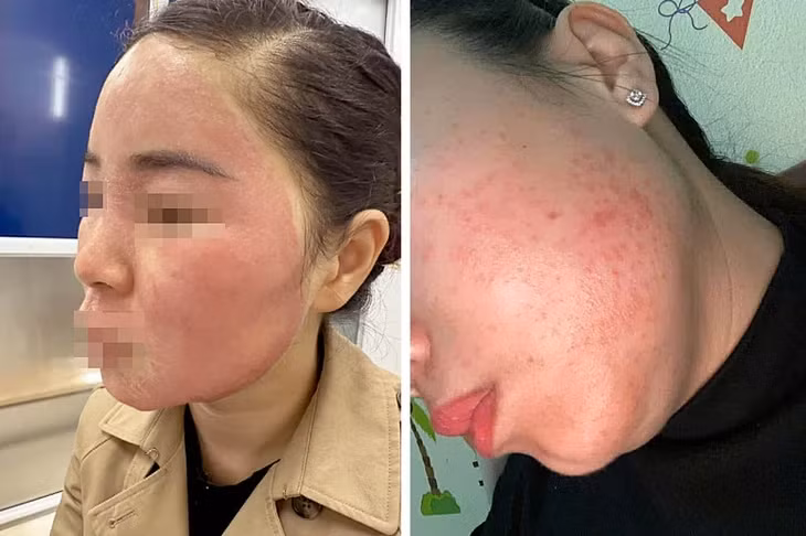 Hai người bệnh bị viêm da do tự dùng tretinoin sai liều - Ảnh: BVCC - CHÂU SA