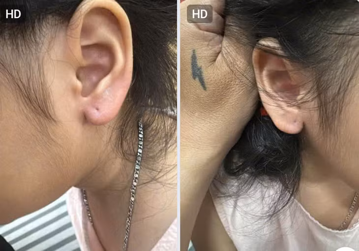 Vùng tai của bé Th bị tổn thương sau khi bị kẻ gian giật mạnh đôi bông tai vàng. Ảnh: Đ.H.T