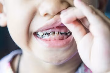 Khi răng mới bắt đầu sâu, bạn không chủ động điều trị sớm, tình trạng có thể trở nên nghiêm trọng hơn. Ảnh: Emmanuelosemotafoundation.