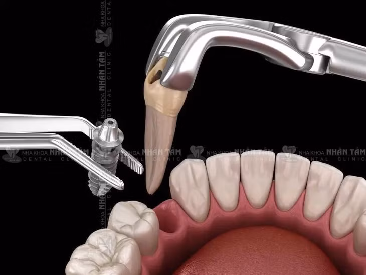 Trồng răng Implant ngay sau khi nhổ răng