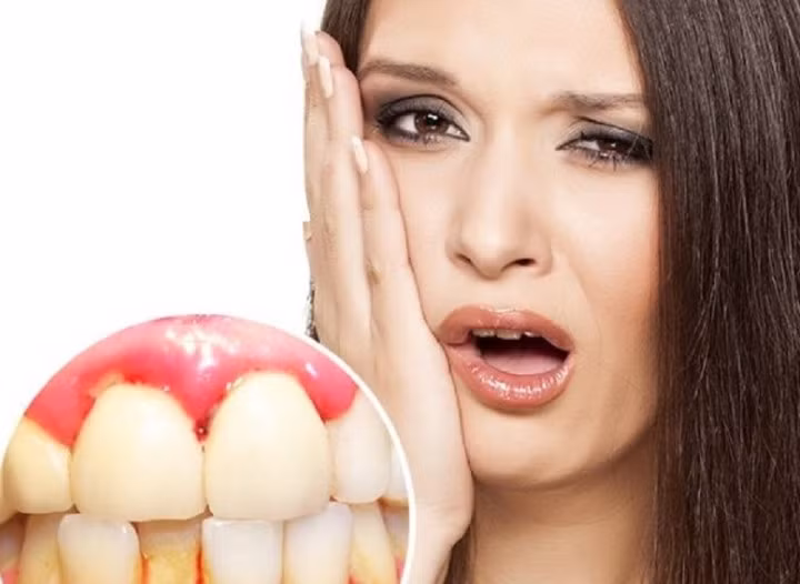 Chân răng bị chảy máu có thể do đánh răng quá mạnh, cũng có thể do bệnh gan.
