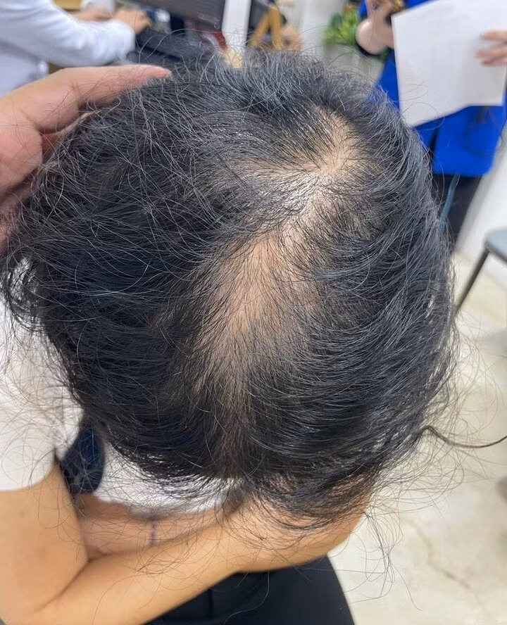 Một số trường hợp rụng tóc sau khi áp dụng No Poo. (Ảnh: BS Thành cung cấp)