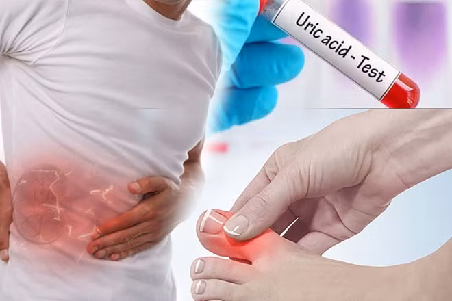 Axit uric cao có liên quan đến gan và thận. Đồ hoạ: Ngọc Thuỳ