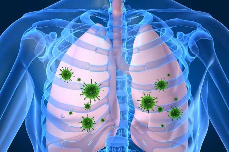 Viêm phổi lúc đầu có thể do virus cúm gây nên nhưng sau đó nhanh chóng chuyển sang bội nhiễm thêm các loại vi khuẩn như phế cầu và tụ cầu.
