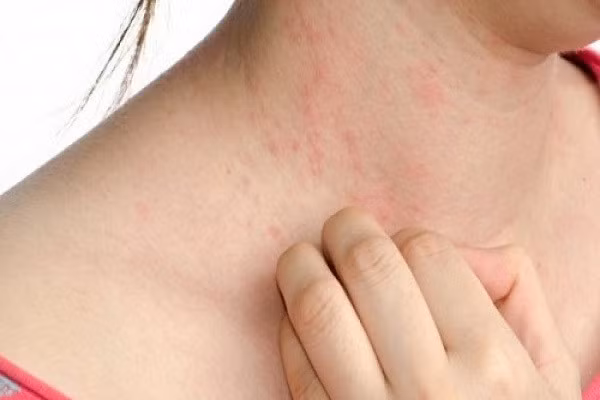 Phòng ngừa dị ứng là rất quan trọng. Ảnh minh họa