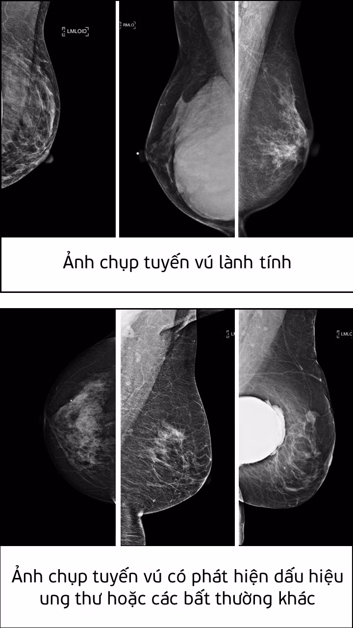 Sau khi được huấn luyện, mô hình AI sẽ có khả năng nhận diện bệnh ung thư thông qua hình ảnh. Hình trên là ảnh chụp tuyến vú lành tính và tuyến vú có phát hiện dấu hiệu ung thư hoặc các bất thường khác.