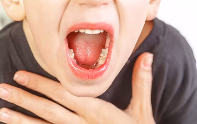 Viêm amidan quá phát là tình trạng amidan bị viêm nhiễm nhiều lần và kéo dài lâu ngày.