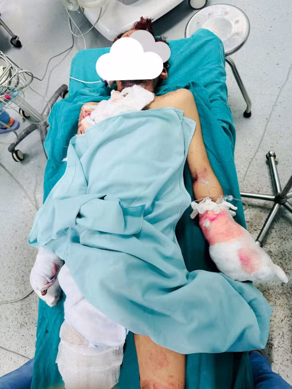 Vụ nổ khiến nam sinh bị thương tích khá nặng, phải tháo khớp bàn tay trái.