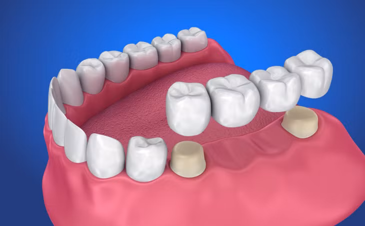 Cầu răng sứ là phương pháp phục hình truyền thống, sử dụng hai răng kế cận để làm trụ nâng đỡ mão sứ thay thế răng bị mất.