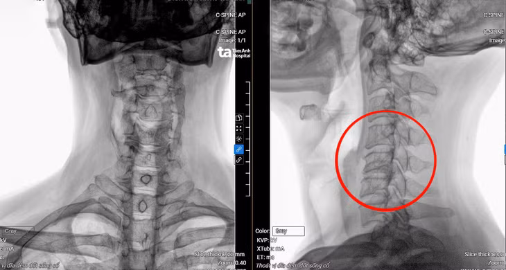 Phim chụp MRI hiển thị vị trí đốt sống cổ bị thoát vị, tổn thương tủy. Ảnh: BV
