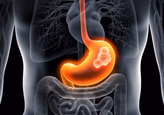 Loại vi khuẩn có thể gây ung thư dạ dày mà nhiều người Việt bị nhiễm ảnh 2