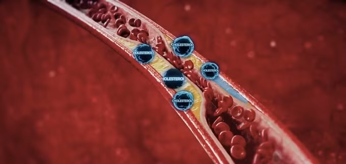 Cholesterol xấu lắng đọng ở thành mạch máu tạo nên các mảng xơ vữa động mạch.