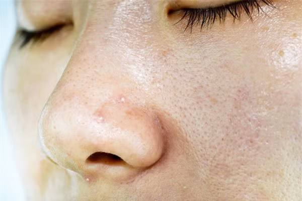 Da dầu cần có cách chăm sóc đúng để hạn chế tình trạng nhiễm vi khuẩn.