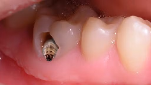 Sâu răng gây ảnh hưởng nghiêm trọng đến sức khỏe răng miệng