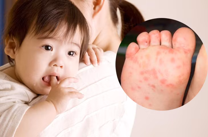 Bệnh tay chân miệng do virus gây ra nên không có thuốc điều trị đặc hiệu. Ảnh minh hoạ.